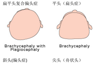 预防宝宝平头扁头 婴儿如何塑造好头型 定型枕头没用
